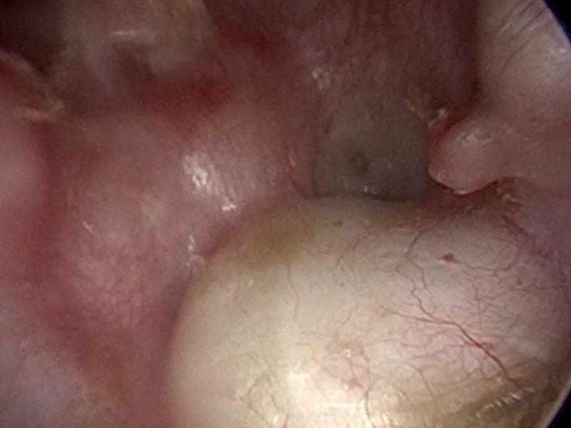 Timpanoplastia Restaura a Audição em Pacientes de Floripa