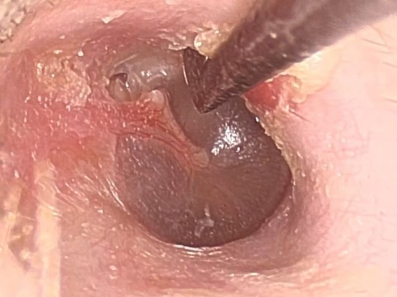 Timpanoplastia com Técnicas Minimamente Invasivas em Florianópolis Benefícios para o Paciente